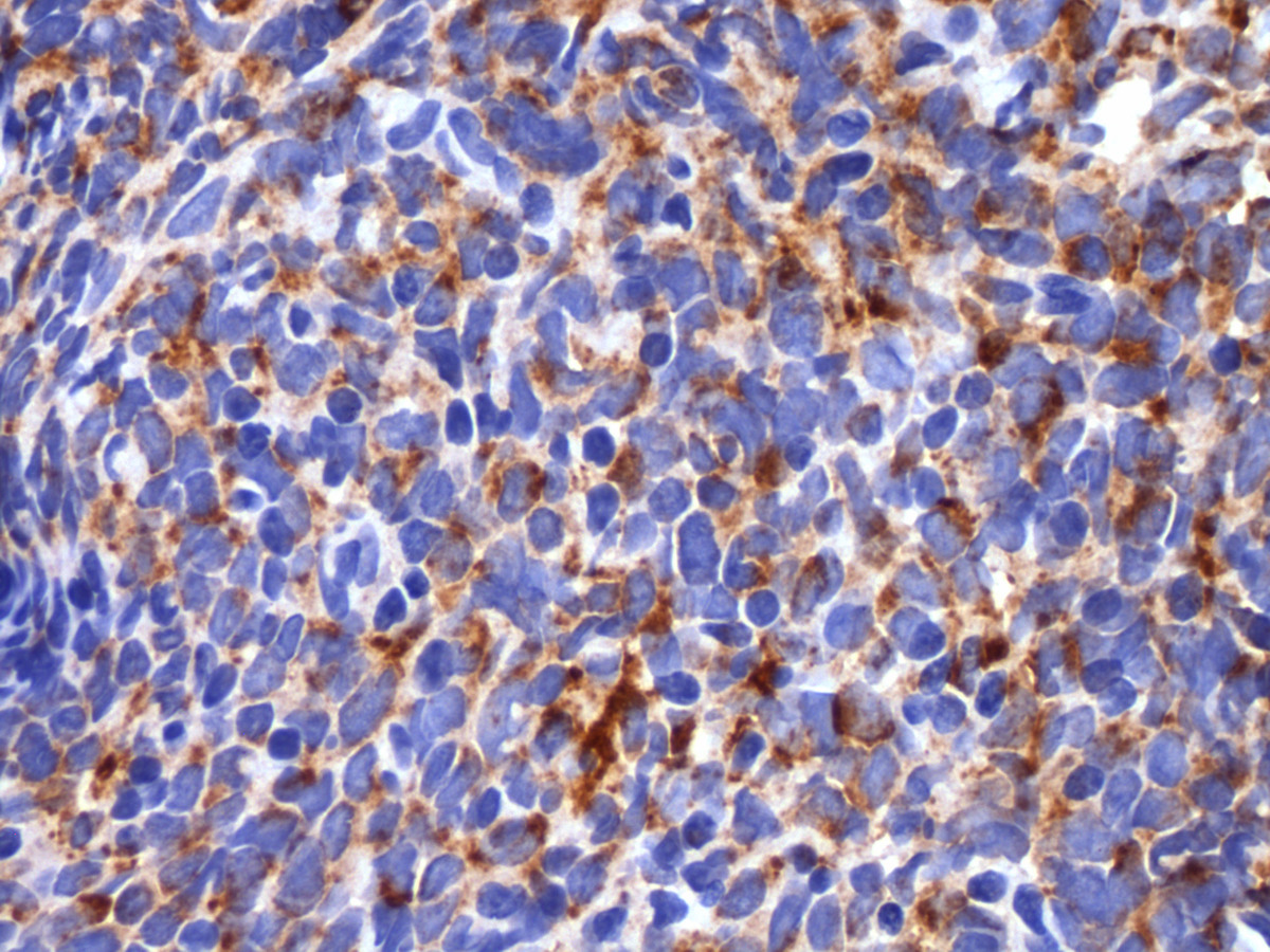 Immunohistochemical stain shows that the neoplastic cells are positive for CD68 (400x).